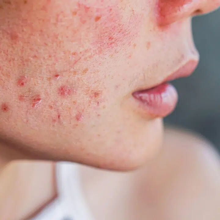 Can Food Sensitivities Cause Acne and Eczema?