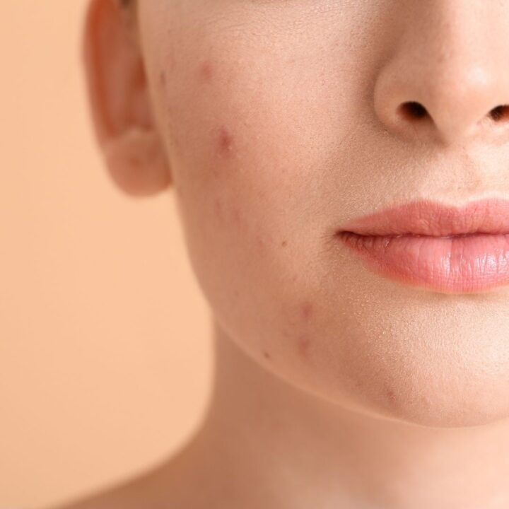 your skin how hormones play a role