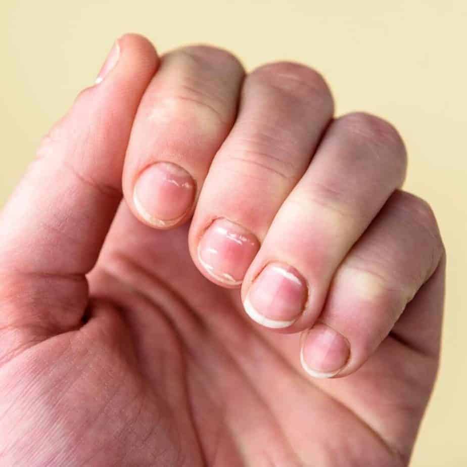 Weak, brittle nails with white spots and ridges is a symptom of a micronutrient deficiency. 
