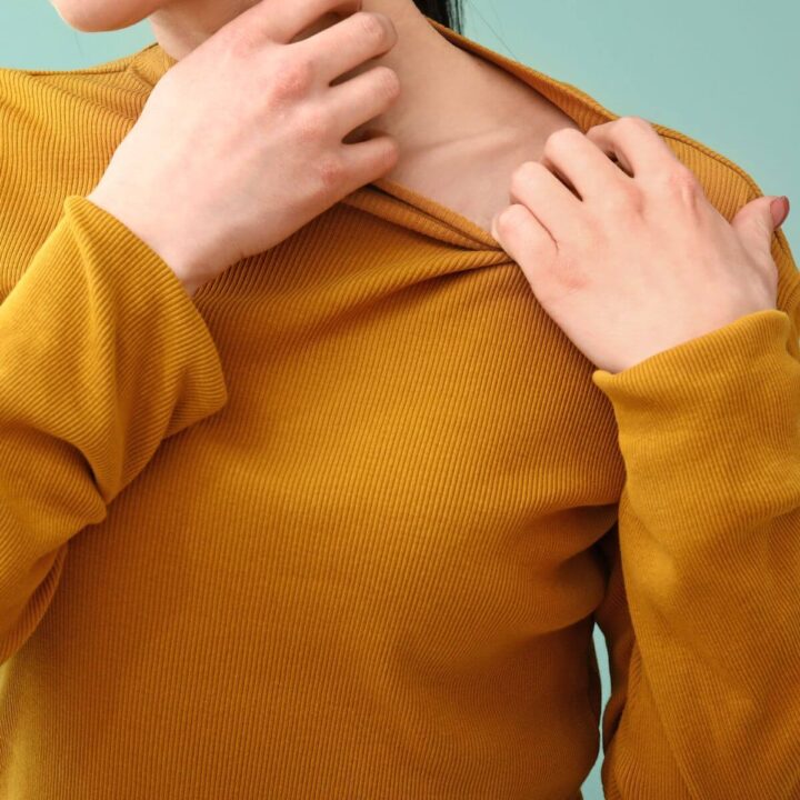 Can Hormonal Changes Cause Hives?