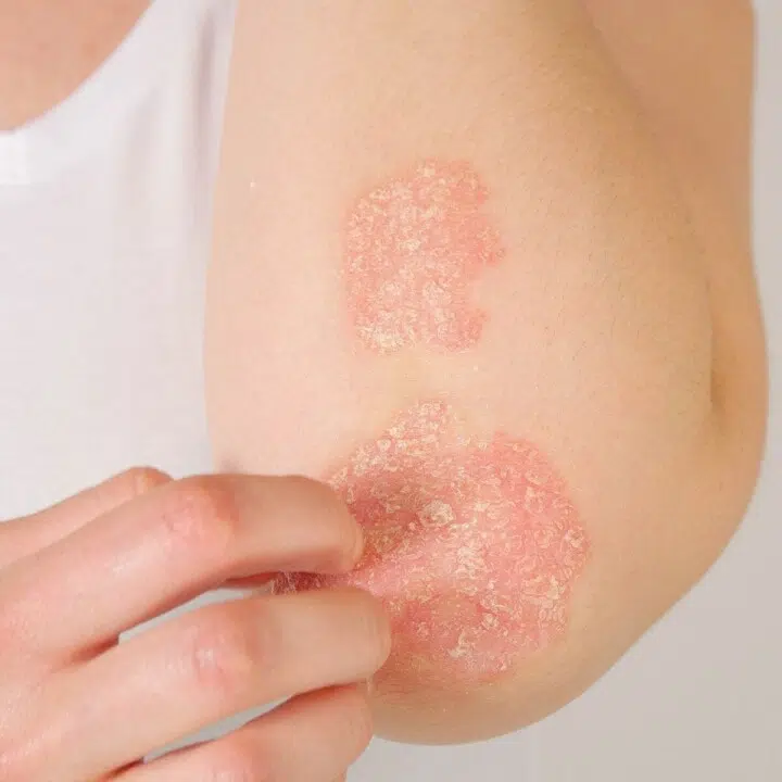 psoriasis